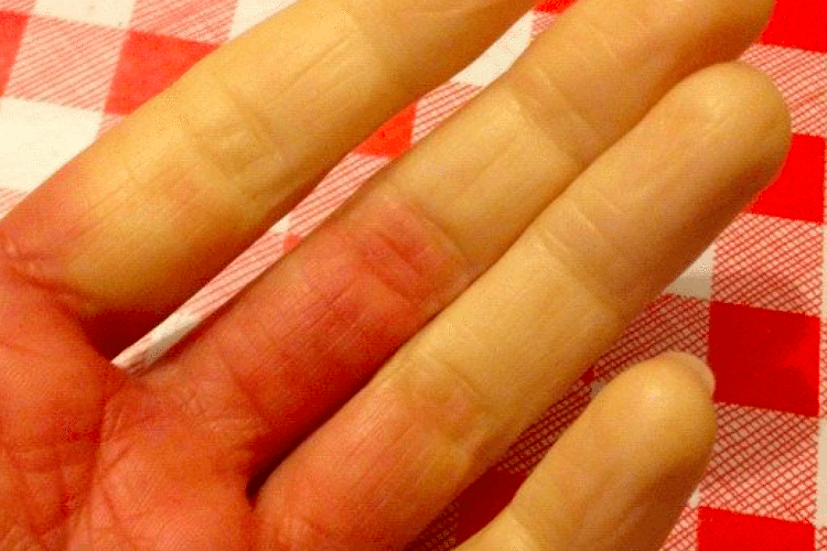 Facts Of Life For People With Raynaud's Disease - Simplemost
