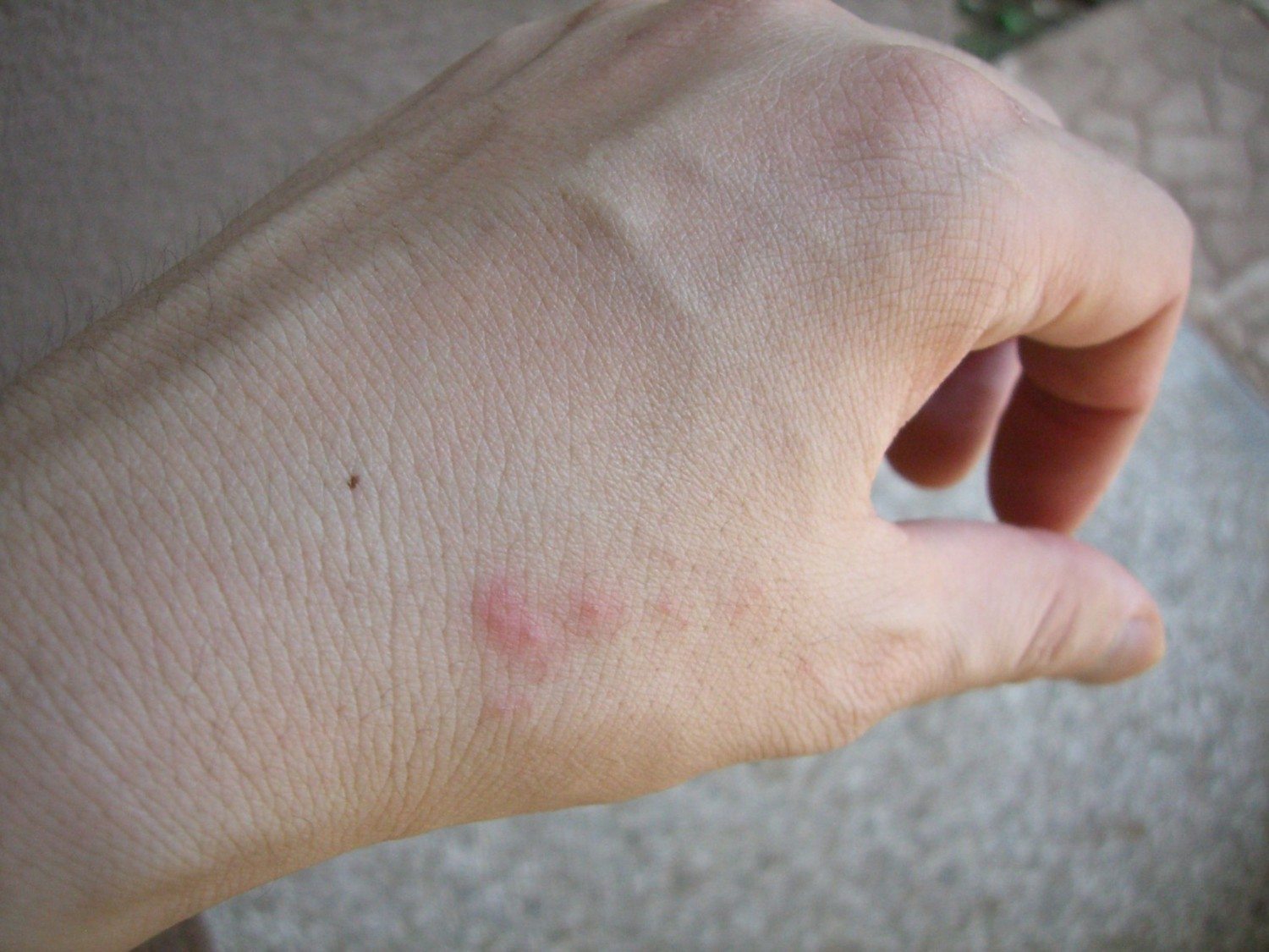 photos of bug bites that itch