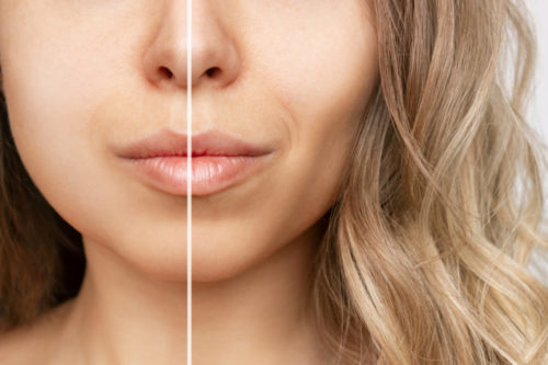 What Is Buccal Fat, And Why Are People Removing It?