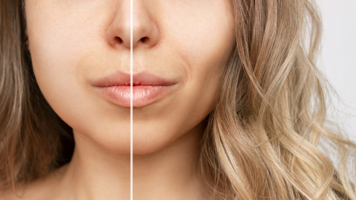 What is buccal fat, and why are people removing it?